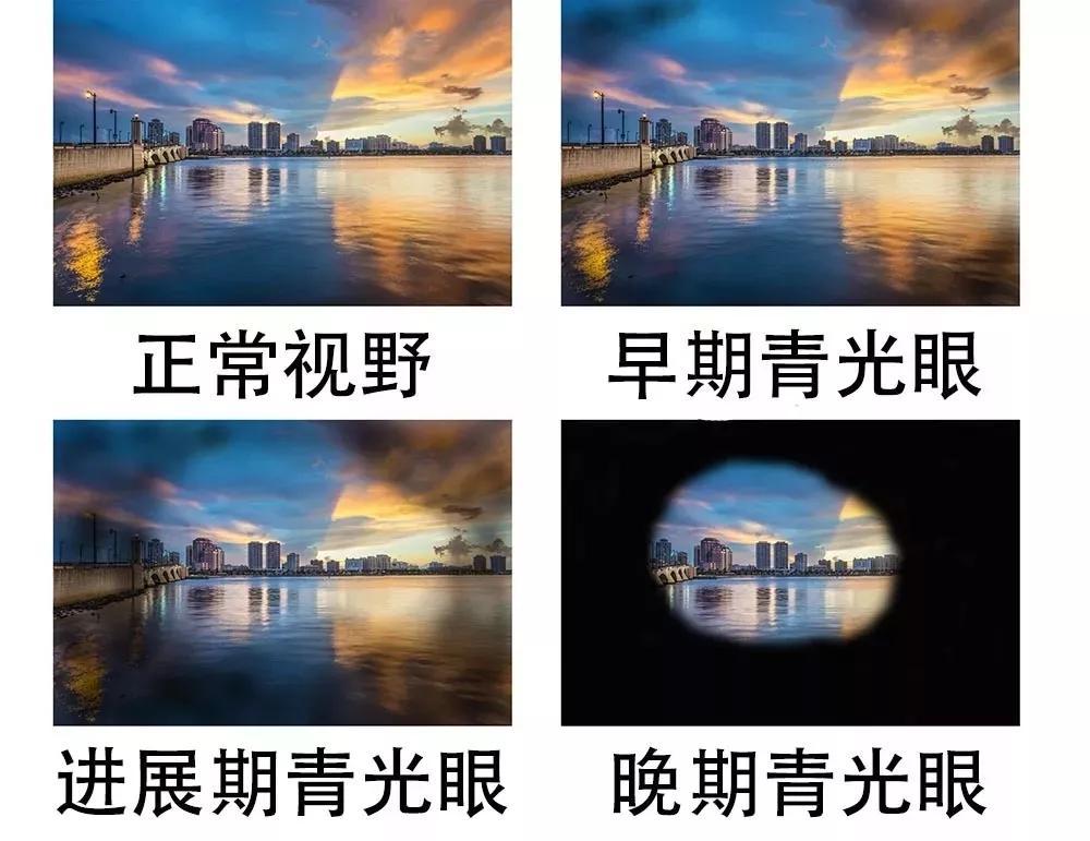 青光眼1.jpg