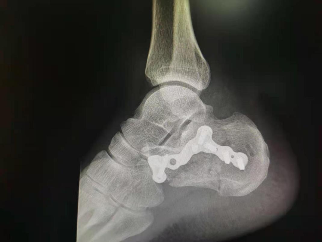 狗狗意外导致左侧髂骨骨折，危急情况应该如何处理并治疗？ - 知乎