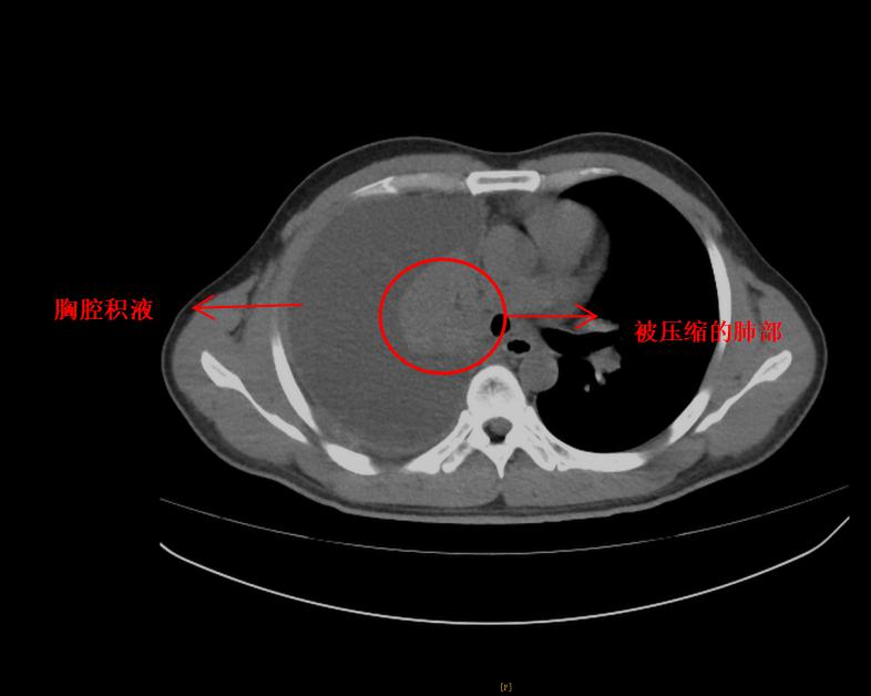 胸腔镜2（1）6.jpg